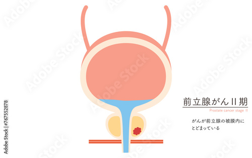前立腺の医療イラスト、前立腺癌のステージ2