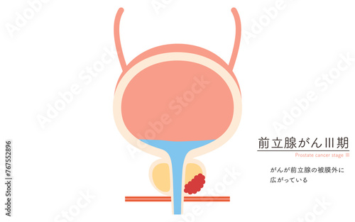前立腺の医療イラスト、前立腺癌のステージ3