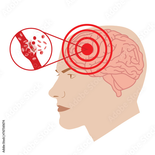 Illustration of a man with hemorrhagic brain or stroke, illustration on white background