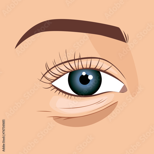 Puffy eye bag close-up of aging woman's face, illustration.
