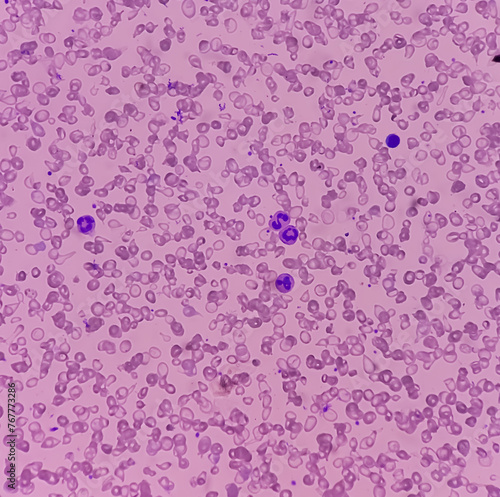 Blood smear, Hereditary hemolytic anemia. Hemoglobin E (HbE) disease. pencil cell, target cell, tear drop cell. occasional nRBC incresed. Thalassemia disease. photo