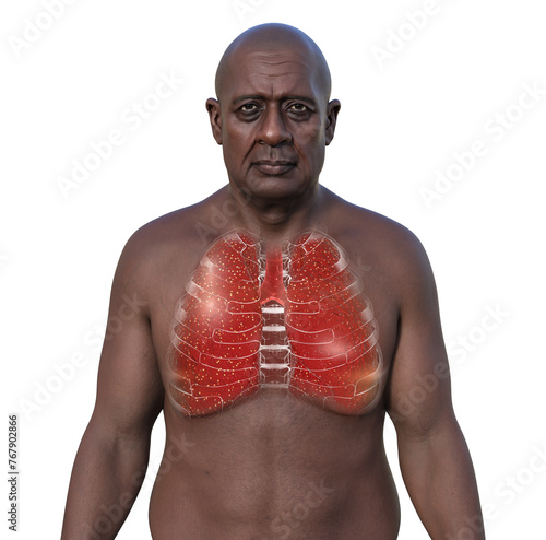 A man with lung miliary tuberculosis, 3D illustration photo