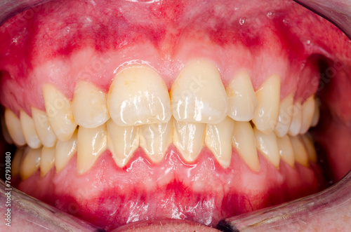 teeth of a person with plaque and gingivitis