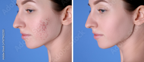 Acne problem. Young woman before and after treatment on blue background, collage of photos