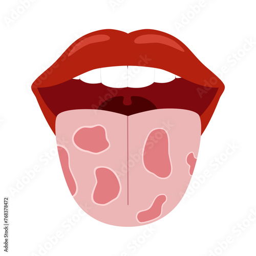 Tongue disease in flat design on white background.