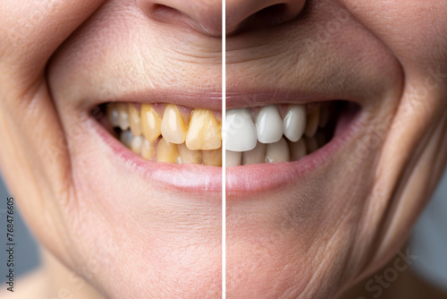 A close-up comparison of a senior woman’s smile, before and after teeth whitening