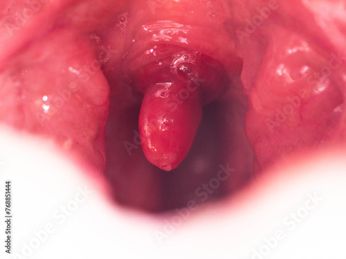 Uvulitis and sore throat in the oral cavity due to illness. Inflammation of the uvula and tonsils due to infections during illness, close-up, streptococcus. Allergy photo
