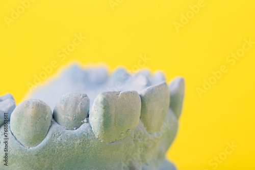 Blue plaster model of an impression of a patient's jaw at an orthodontist dentist on a yellow background. Manufacturing of dentures and crowns for dental prosthetics in orthodontics, macro.  photo