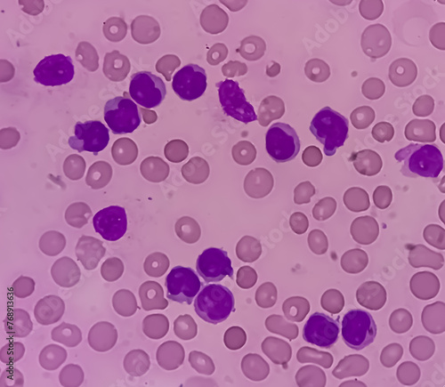 Lymphocytosis with Thrombocytopenia. Smear show white blood cells, red blood cells background. Lymphoproliferative disorder. photo