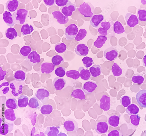 Lymphocytosis with Thrombocytopenia. Smear show white blood cells, red blood cells background. Lymphoproliferative disorder.