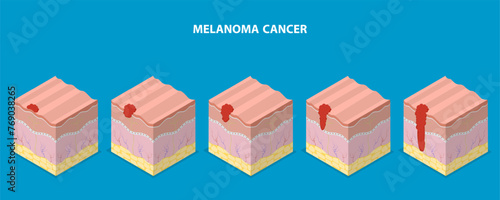 3D Isometric Flat Vector Illustration of Melanoma Cancer, Dermatology and Skin Health