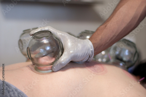 Medicina Tradicional China (MTC) terapia alternativa con ventosas y acupuntura 