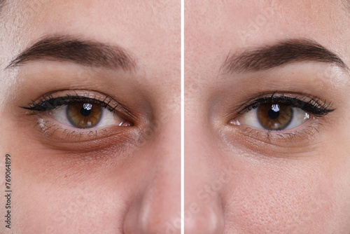 Collage with photos of woman with dark circle under eye before and after treatment, closeup