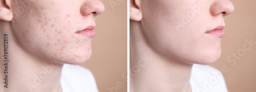 Acne problem. Young man before and after treatment on beige background, closeup. Collage of photos photo