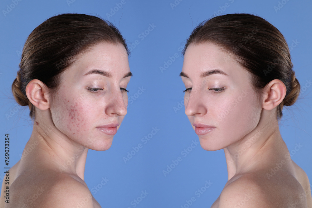 Acne problem. Young woman before and after treatment on blue background, collage of photos Acne problem. Young woman before and after treatment on blue background, collage of photos