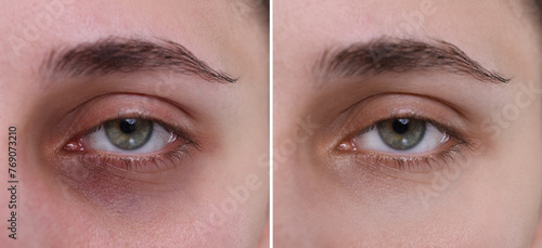 Collage with photos of woman with dark circle under eye before and after treatment, closeup