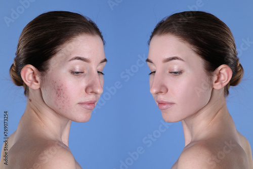 Acne problem. Young woman before and after treatment on blue background, collage of photos