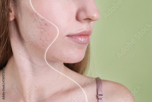 Acne problem, collage. Woman before and after treatment on green background, closeup photo