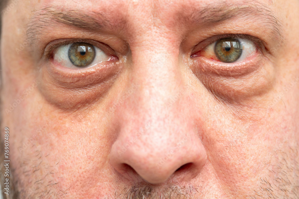 Redness of the eye, possible consequences of capillary rupture or infection, visible hemorrhage. Close-up of a man's face. Redness of the eye, possible consequences of capillary rupture or infection, visible hemorrhage. Close-up of a man's face.
