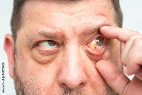 Redness of the eye, possible consequences of capillary rupture or infection, visible hemorrhage. Close-up of a man's face.