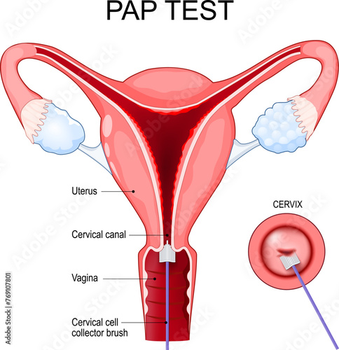 Pap test procedure. Cross section of a human uterus. Close-up of a Cervix photo