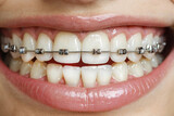 Close up of teeth with braces, orthodontic treatment for straightening teeth in young. A young woman with braces on her teeth is smiling