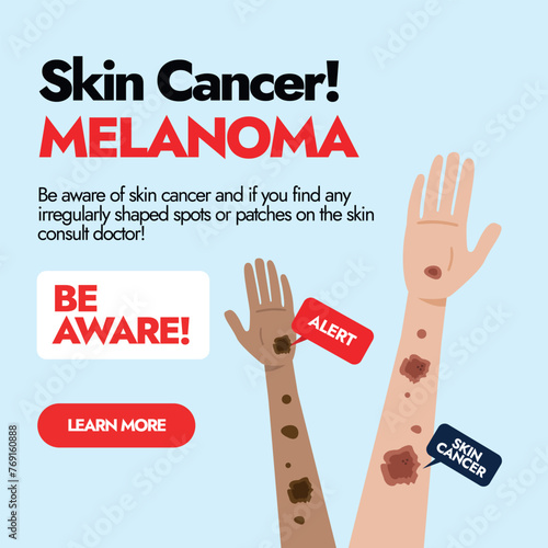 Melanoma Skin cancer. Skin cancer awareness post with two different ethnic hands having Melanoma cancer spots. Awareness social media post for Skin Cancer Patients. Melanoma warning signs.