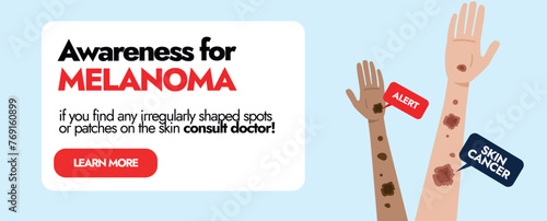 Melanoma Skin disease. Skin cancer awareness cover with two different ethnic hands having Melanoma cancer spots. Awareness social media banner for Skin infection Patients. Melanoma warning signs.