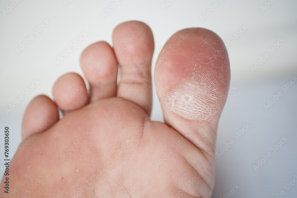 close up of young man dry feet on bed , close up of young man dry feet on bed ,