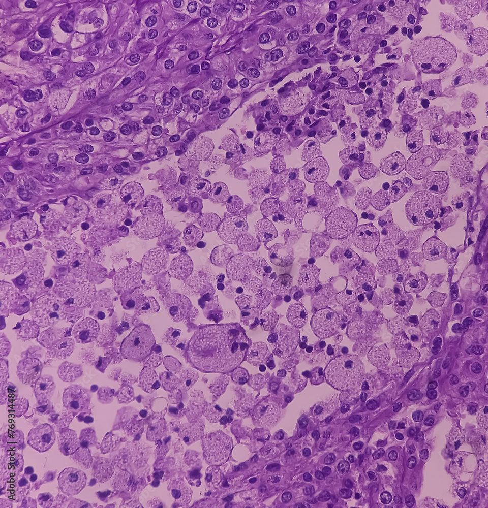 Kidney cancer Clear cell carcinoma. fuhrman nuclear gradeII, Renal