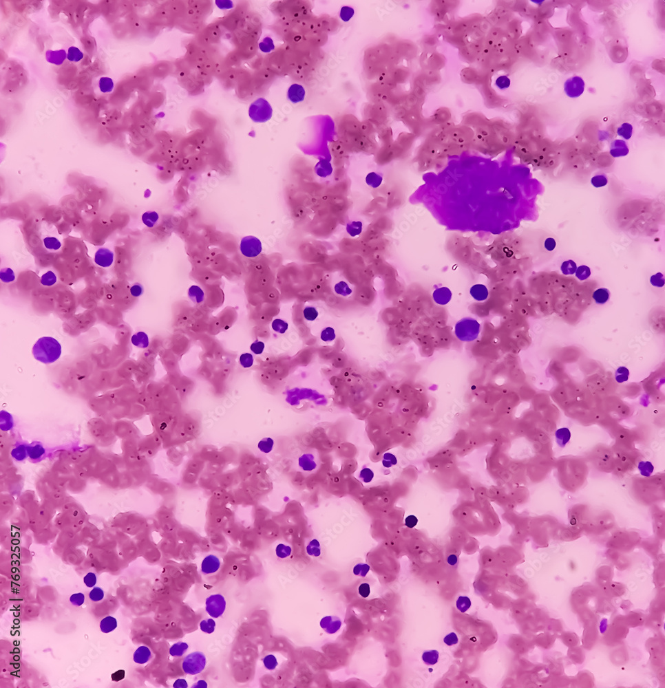 Bone marrow study. Panmyelosis. Myeloproliferative disorder ...