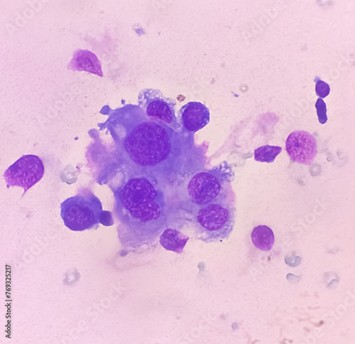 Ascitic fluid cytology. Leishman stain smear show Lymphocytes, polymorphs cells. Abnormal cells. Ascites. photo