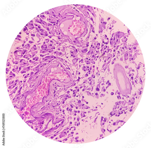 Astrocytoma, Intramedullary SOL (C5-D3) tissue biopsy. Photomicrograph show malignant neoplasm of oval to elongated cells with eccentric cuclei and eosinophilic cytology. Micovascular proliferation. photo