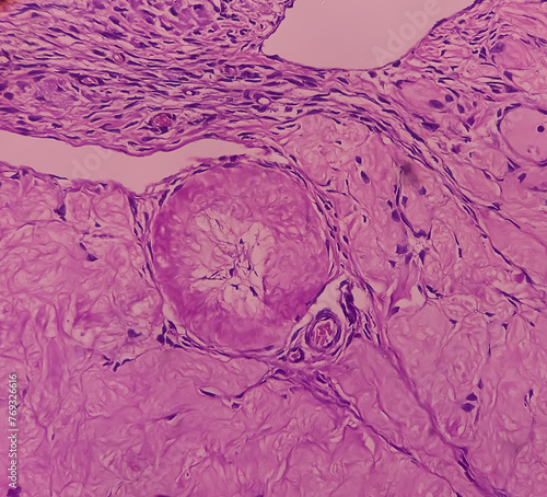 Uterus with adnexa (biopsy): Cervix show chronic inflamatory cells, wall show secretory phase in endometrium and fallopian tube show paratubal cyst. fimbrial cyst, Paraovarian cyst. photo