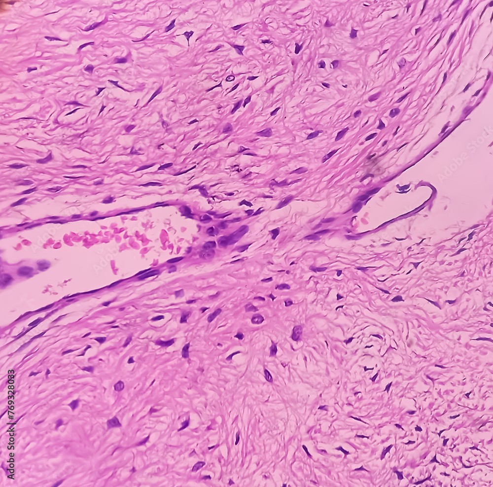 Fibromyxoma. Leg tissue biopsy: Sections microscopically show features ...