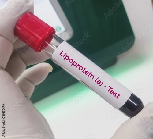 Blood sample for lipoprotein (a) or LpA blood test. Lipid profile. to diagnosis of high risk for heart disease and stroke. Bad cholesterol medical testing concept.