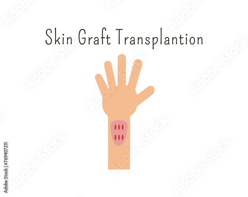 Human organ donation for transplantation concept with hand, suitable for medical banner, infographics and education. Skin graft transplantation. organ donation concept. 