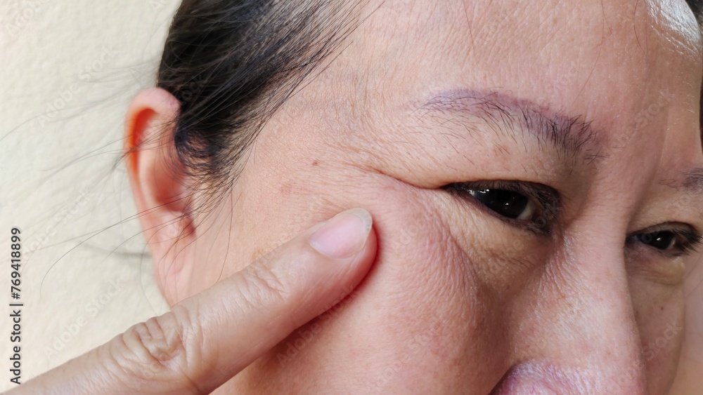 Obraz premium close up the flabbiness and wrinkle beside the eyelid, dark spots and blemish, freckles and loose on the face of the woman, health care and beauty concept.