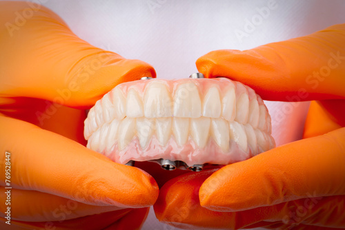 Zirconium crowns on titanium bar. Total rehabilitation on implants.