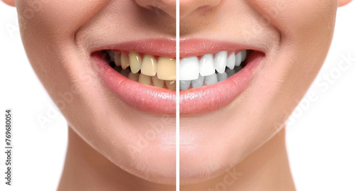 Woman's smiling mouth is divided into two parts, one with teeth that have dark yellowish tones and the other part showing white healthy teeth, This concept represents professional dental whitening. 