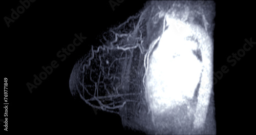 Breast MRI revealing BI-RADS 4 in women indicates suspicious findings warranting further investigation for potential malignancy. photo