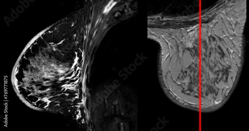 Fotografia Breast MRI revealing BI-RADS 4 in women indicates suspicious findings warranting further investigation for potential malignancy