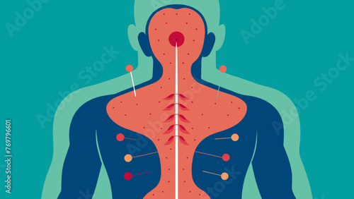 A view from above showing multiple needles positioned along a persons back mapped out to correspond with the meridians of the lungs and