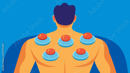  An upclose shot of a cupping session with multiple cups p on the clients back indicating an allover pain relieving treatment.