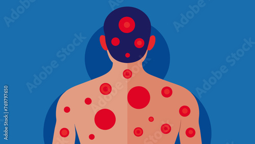  An image of a mans skin after the cups have been removed revealing red circular marks. These marks are caused by the suction and are a normal