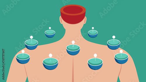  A closeup of a set of small glass cups being arranged on a patients back. The cups are strategically p along energy pathways known as meridians.