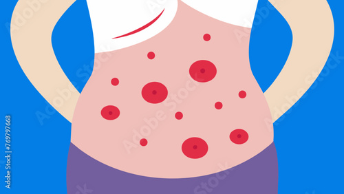  A side view of a persons stomach showing the welts created by traditional Mongolian ing cupping believed to remove toxins and cure illnesses.