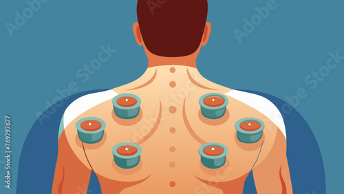  A closeup shot of a patients back with the cups in place. The cups are left on for a few minutes allowing the suction to draw toxins and