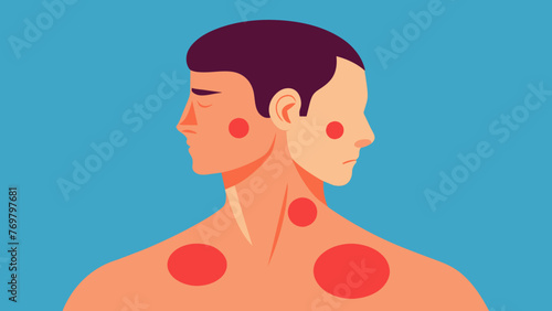 A mans shoulder and neck area before cupping therapy shows redness and inflammation.