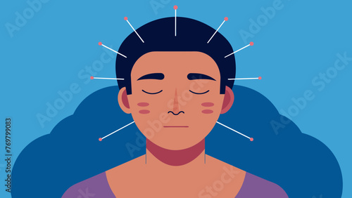  A focused shot of a patients face as they relax with acupuncture needles p on the neck and forehead.
